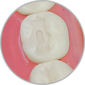 Dente 47 - Classe I (O) em duas profundidades (cod:47.B)