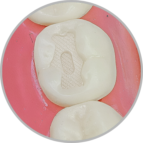 Dente 47 - Classe I (O) em duas profundidades (cod:47.B)