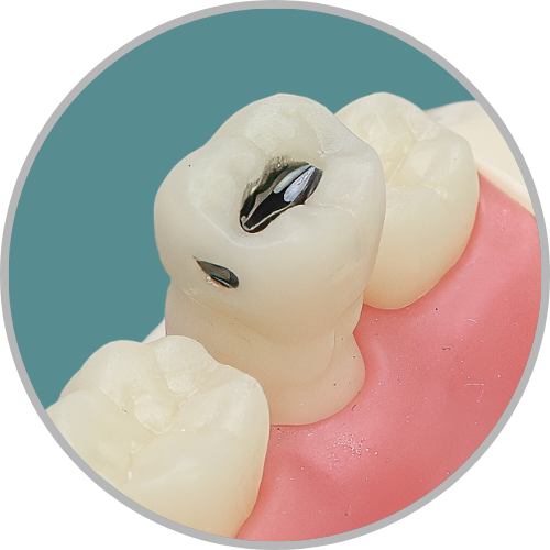 Dente 47 - Lesão de cárie classe II (MO) crista preservada (cod:47.C)