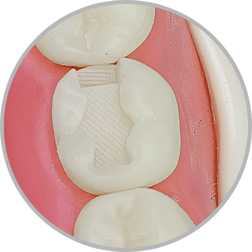 Dente 47 - Classe II (MO) (cod:47.D)