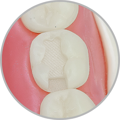 Dente 47 - Classe II (OD) (cod:47.E)