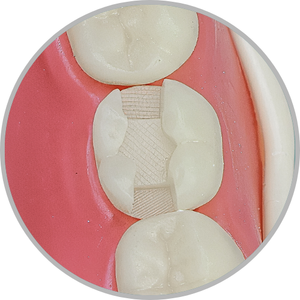Dente 47 - Classe II (MOD) (cod:47.I)