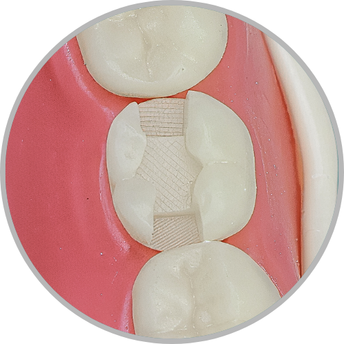Dente 47 - Classe II (MOD) (cod:47.I)