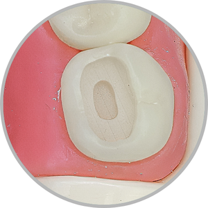 Dente 48 - Classe I (O) extensa em duas profundidades (cod:48.B)