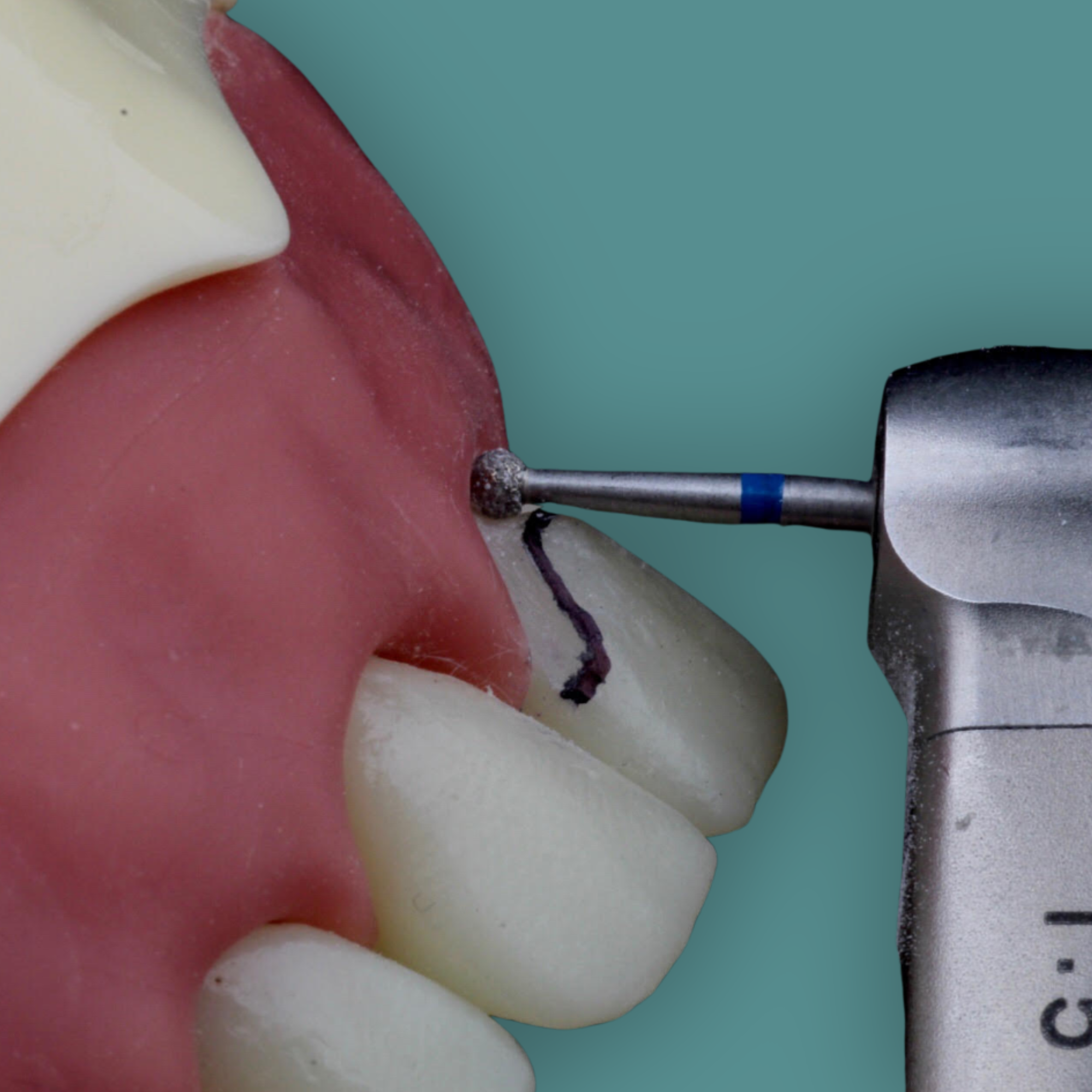 Dente Orais sendo trabalhado com instrumental rotatório